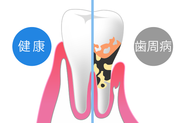 歯周病のケアについて